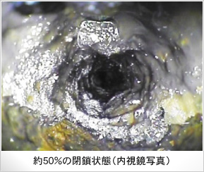 約50％の閉鎖状態（内視鏡写真）
